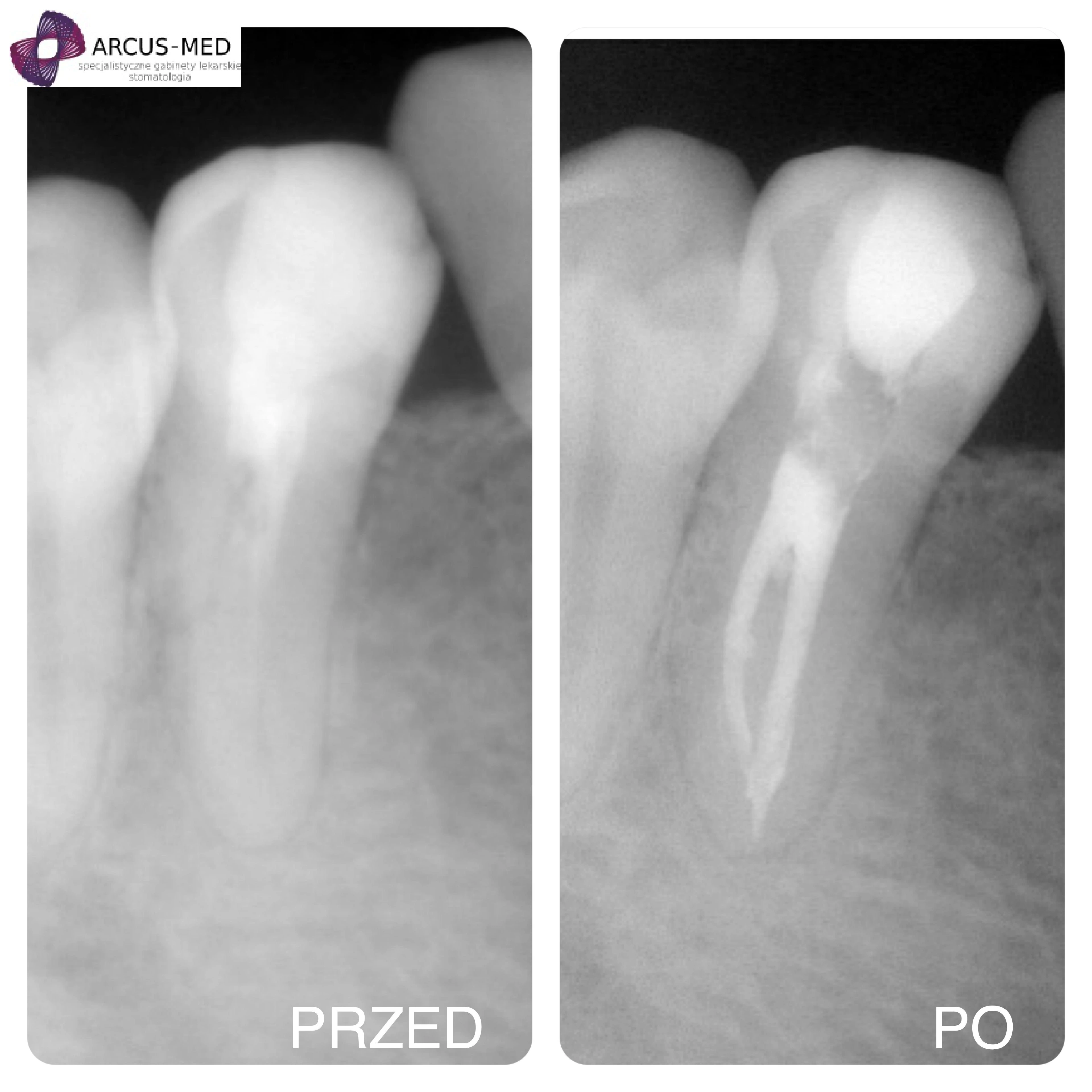 Zdjęcia przed i po leczeniu kanałowym