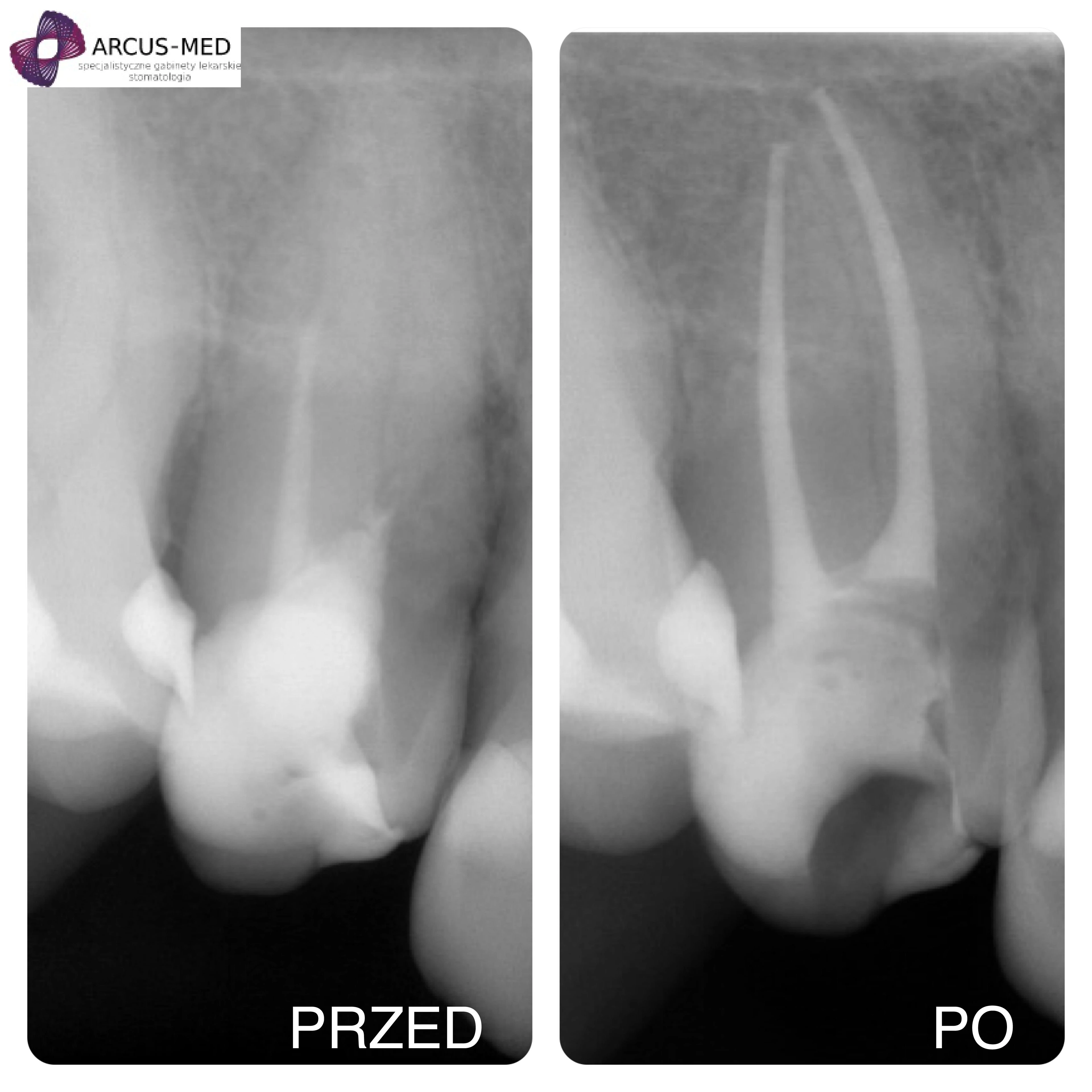 Zdjęcia przed i po leczeniu kanałowym