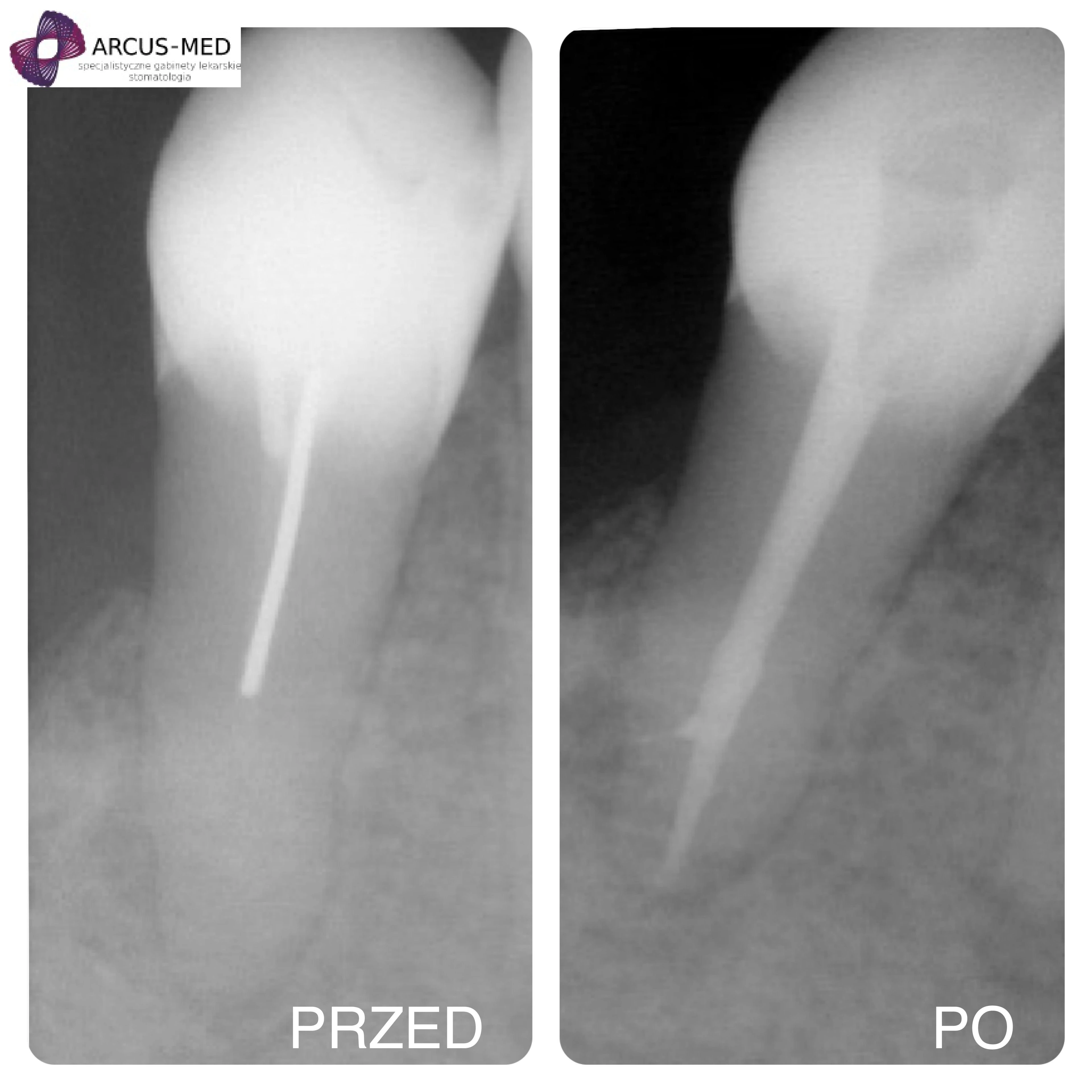 Zdjęcia przed i po leczeniu kanałowym
